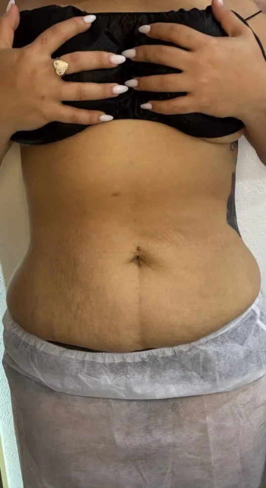 Abdomen antes de los masajes reductores
