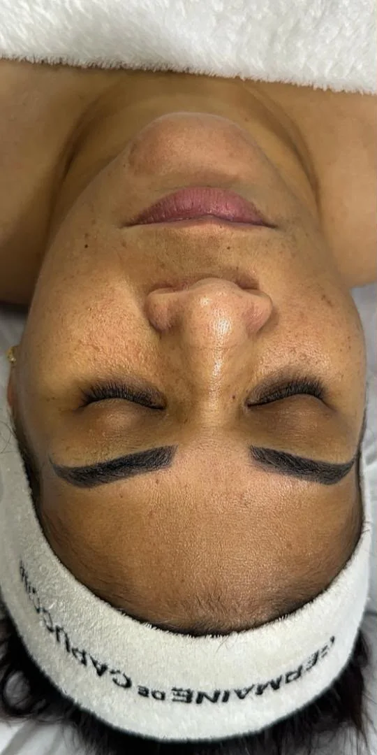 Rostro antes del tratamiento facial