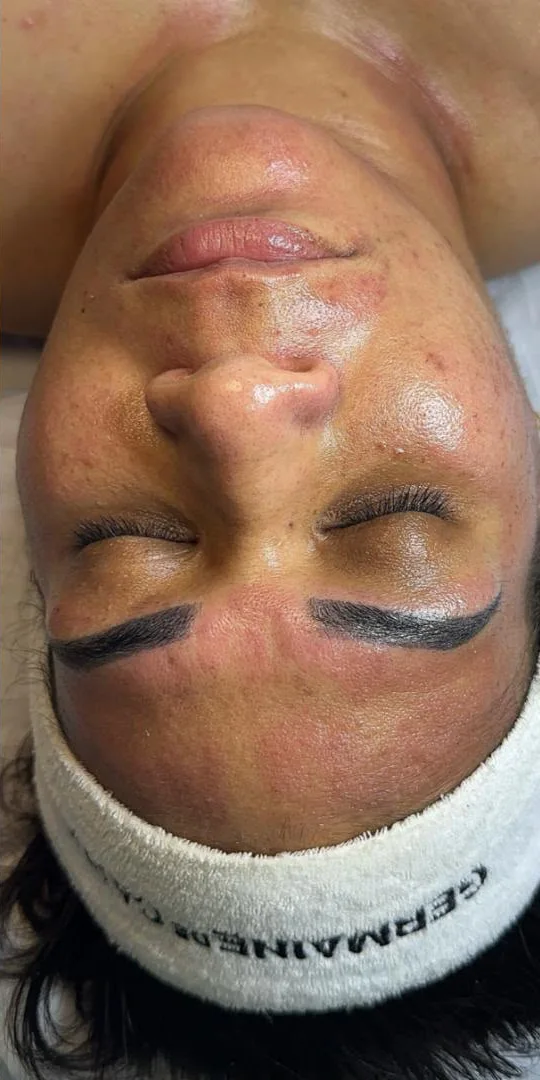 Rostro después del tratamiento facial